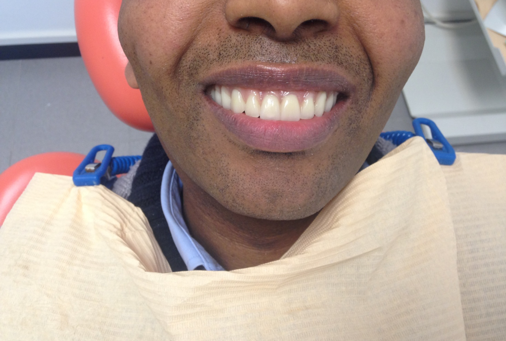 Caso di edentulia totale riabilitato con 6 impianti