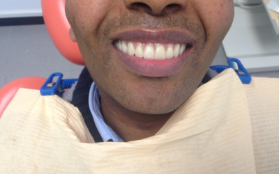 Caso di Edentulia Totale Riabilitato con 4 Impianti (All on Four)