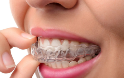 Apparecchio invisibile: ortodonzia estetica e funzionale