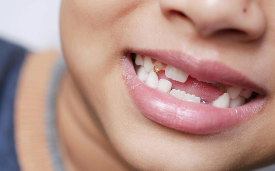🦷 Trauma dentale: cosa fare immediatamente se il bambino perde un dente