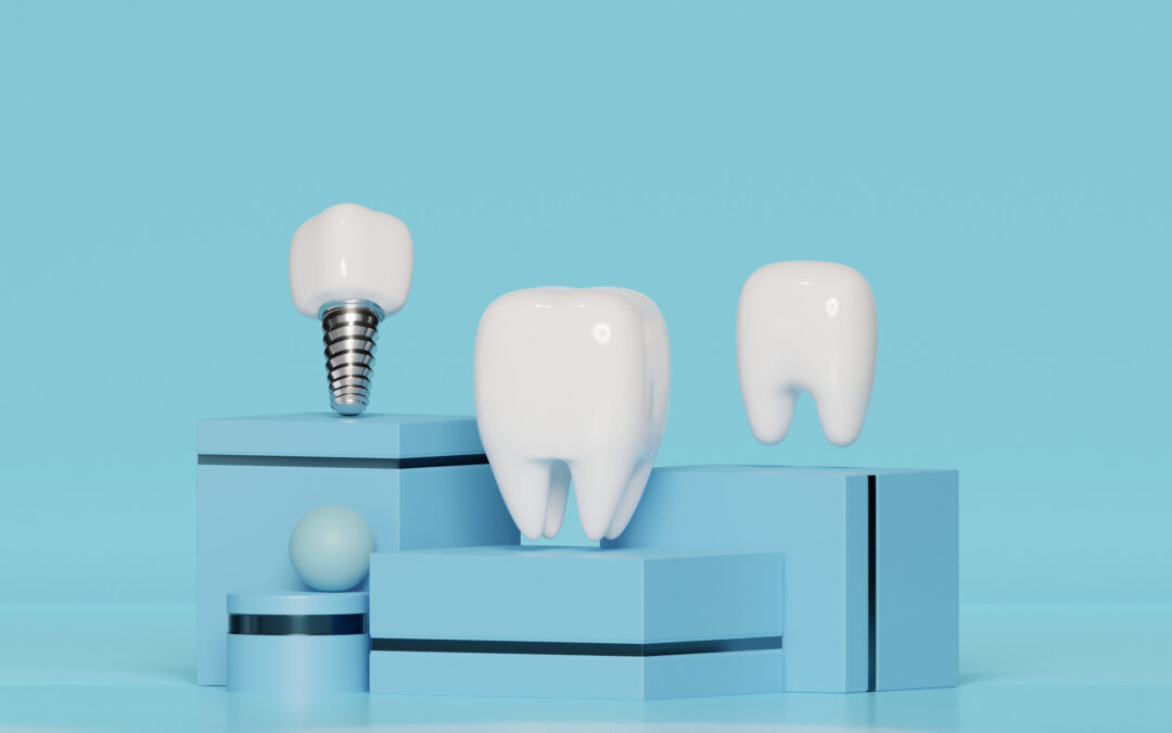 Implantologia moderna: tecniche mini-invasive, carico immediato e rigenerazione ossea