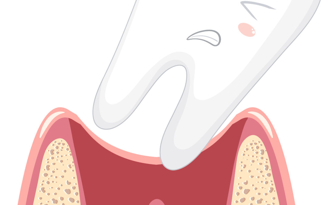 paradontite-cura-a-roma-termini